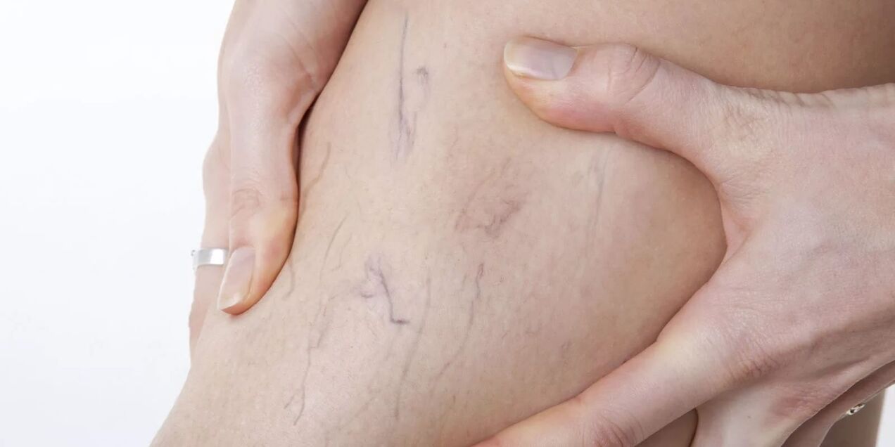 pred uporabo kreme varikona